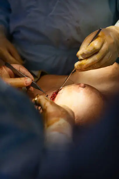 Explantación mamaria segura